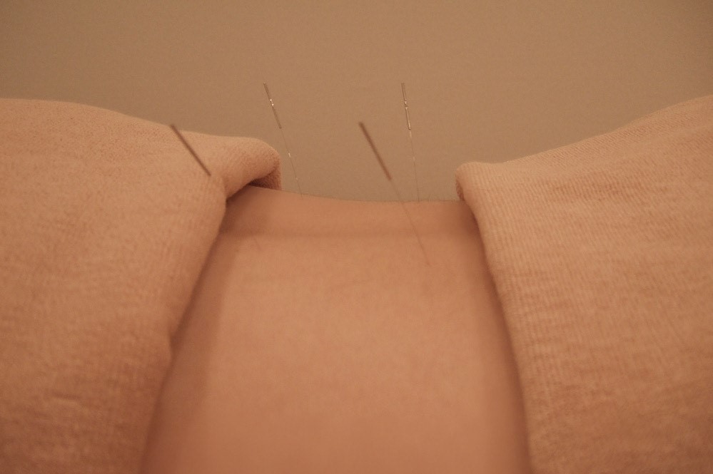 はりきゅうとは